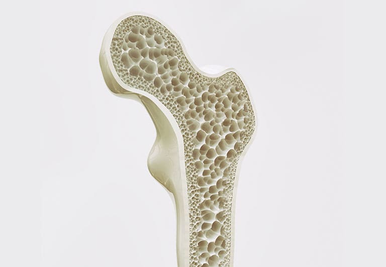 骨粗鬆症について